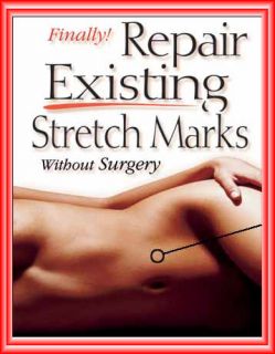 STRETCH MARK Removal  Better than Lotions, Creams, Oils
