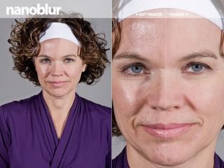 Nanoblur Acne Cream Treatment Melasma Skin Condition