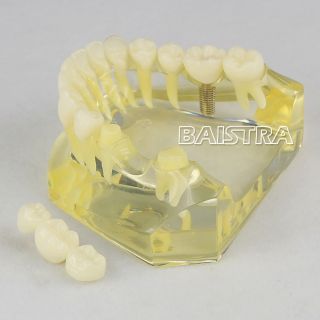 Dental Teeth Study Implant Model Caries Typodont Bridge Orthodontic