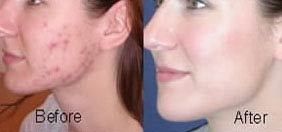 Dermatologist Grade Glycolic Acid Peel 60 Strength Wrinkles Acne Scars